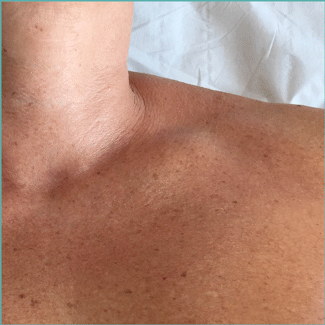 3JUVE Before & After – Remodel-Skin-Tightening