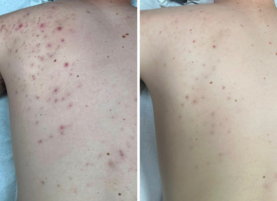 acne-scar-streth-marks-resurface-laser-gosport-lillys