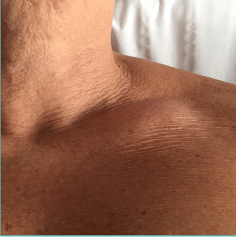 3JUVE Before & After – Remodel-Skin-Tightening